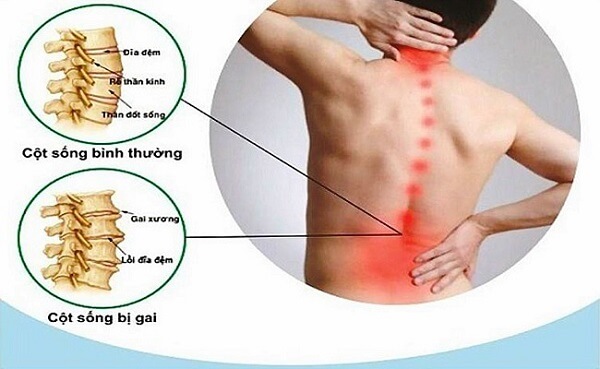 Bệnh gai cột sống là gì, có chữa được không