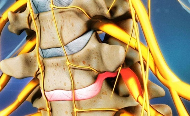 Triệu chứng thoát vị đĩa đệm chèn dây thần kinh